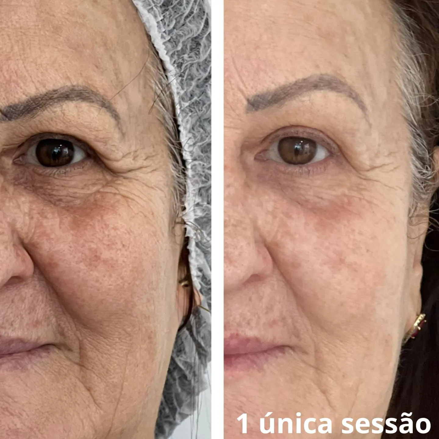 Antes e Depois HIPRO 1