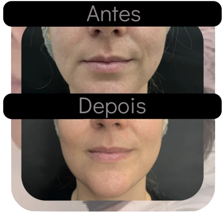 Antes e depois de HIFU Multilinear: lifting facial real na Estética Talita Almeida Moema