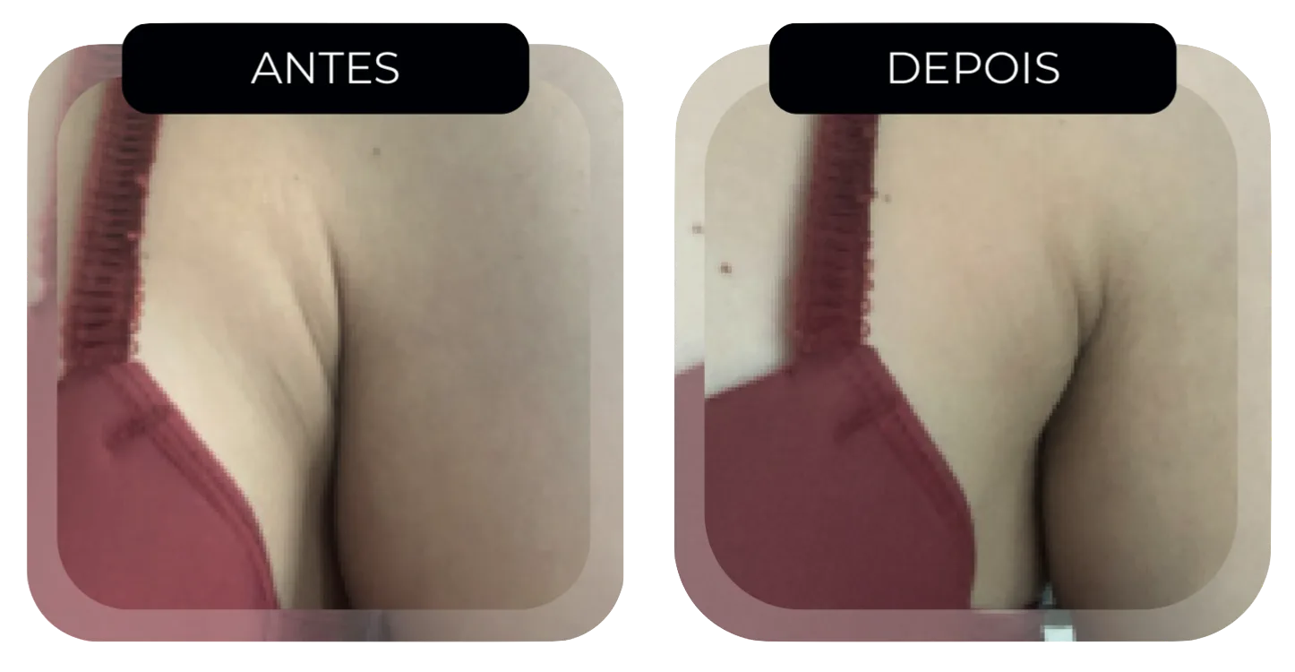Antes e depois HIFU Multilinear: gordura localizada costas tratamento estético real Moema