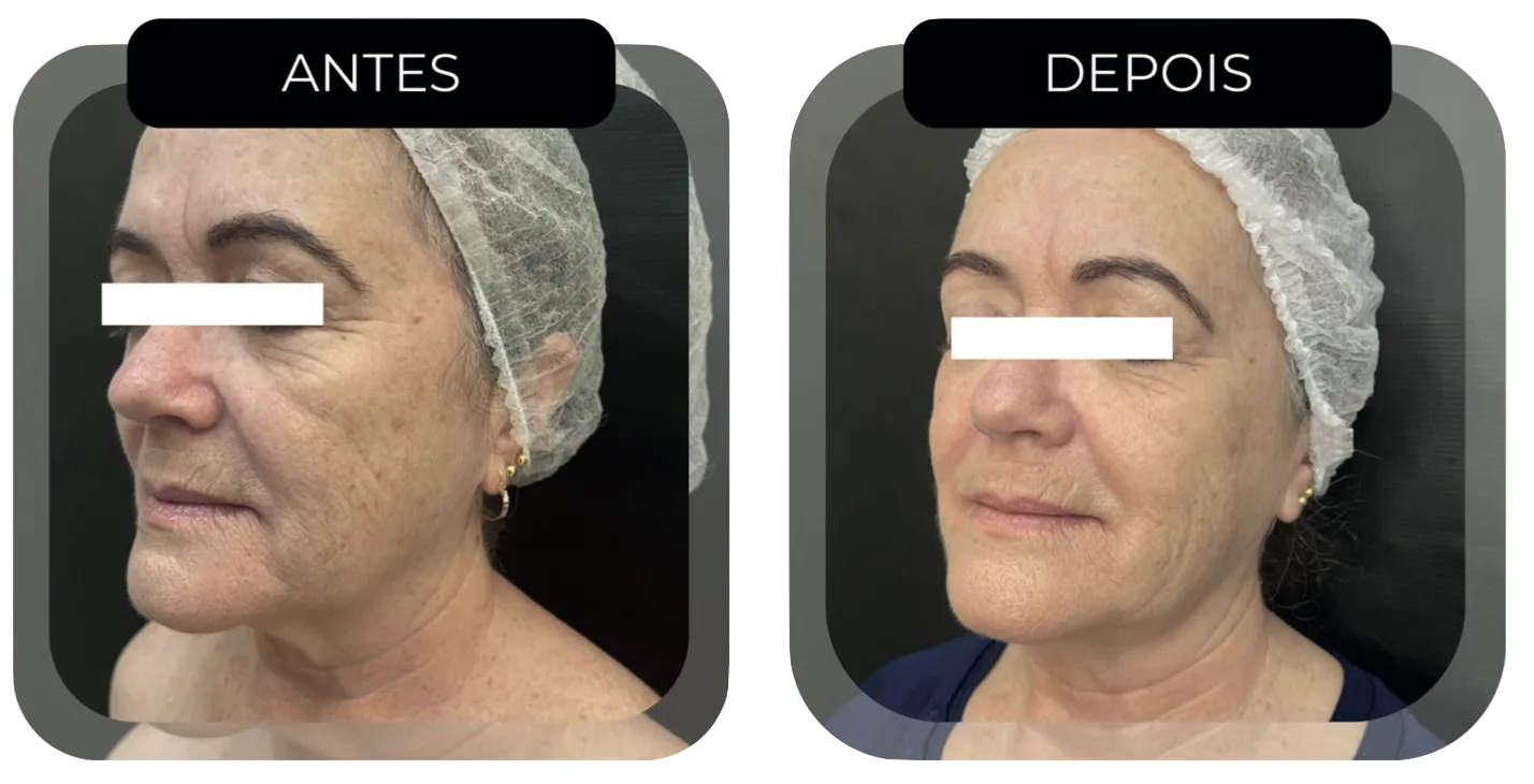 Antes e depois HIFU Multilinear lifting facial em paciente idosa Estética Talita Almeida Moema