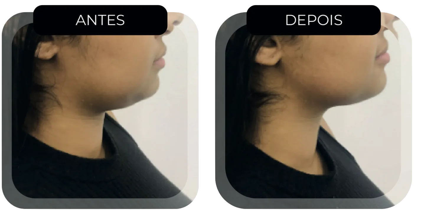 Antes e depois HIFU Multilinear papada contorno mandíbula Moema