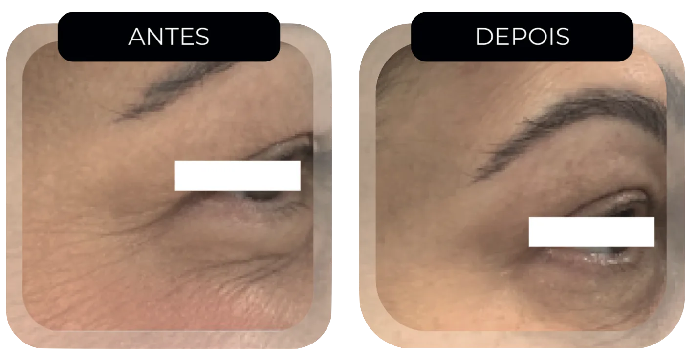 Antes e depois HIFU Multilinear: redução de rugas nos olhos (pé de galinha) paciente feminina Moema