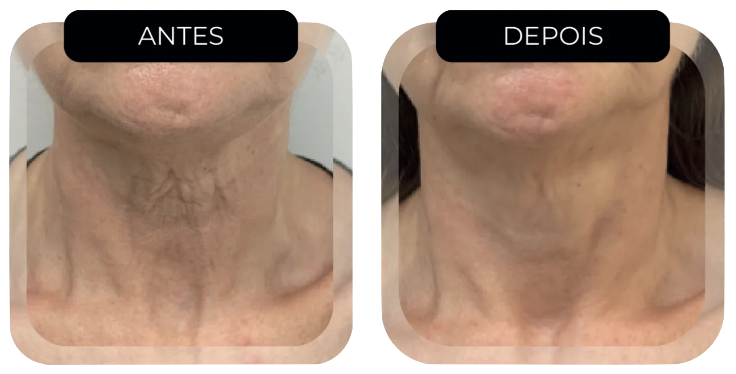 Antes e depois HIFU Multilinear rejuvenescimento pescoço rugas flacidez Moema